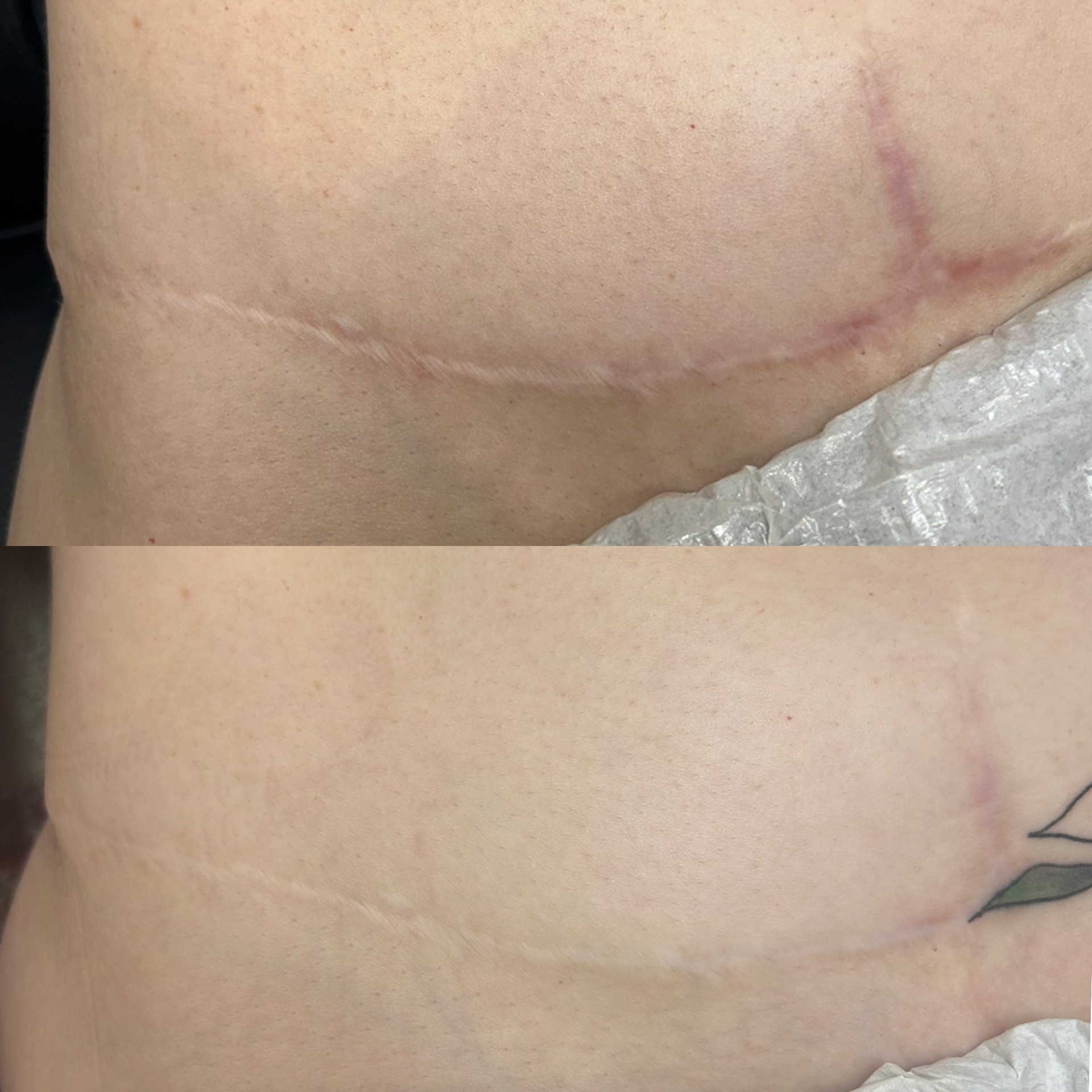 Scar Camouflage in Wentzville